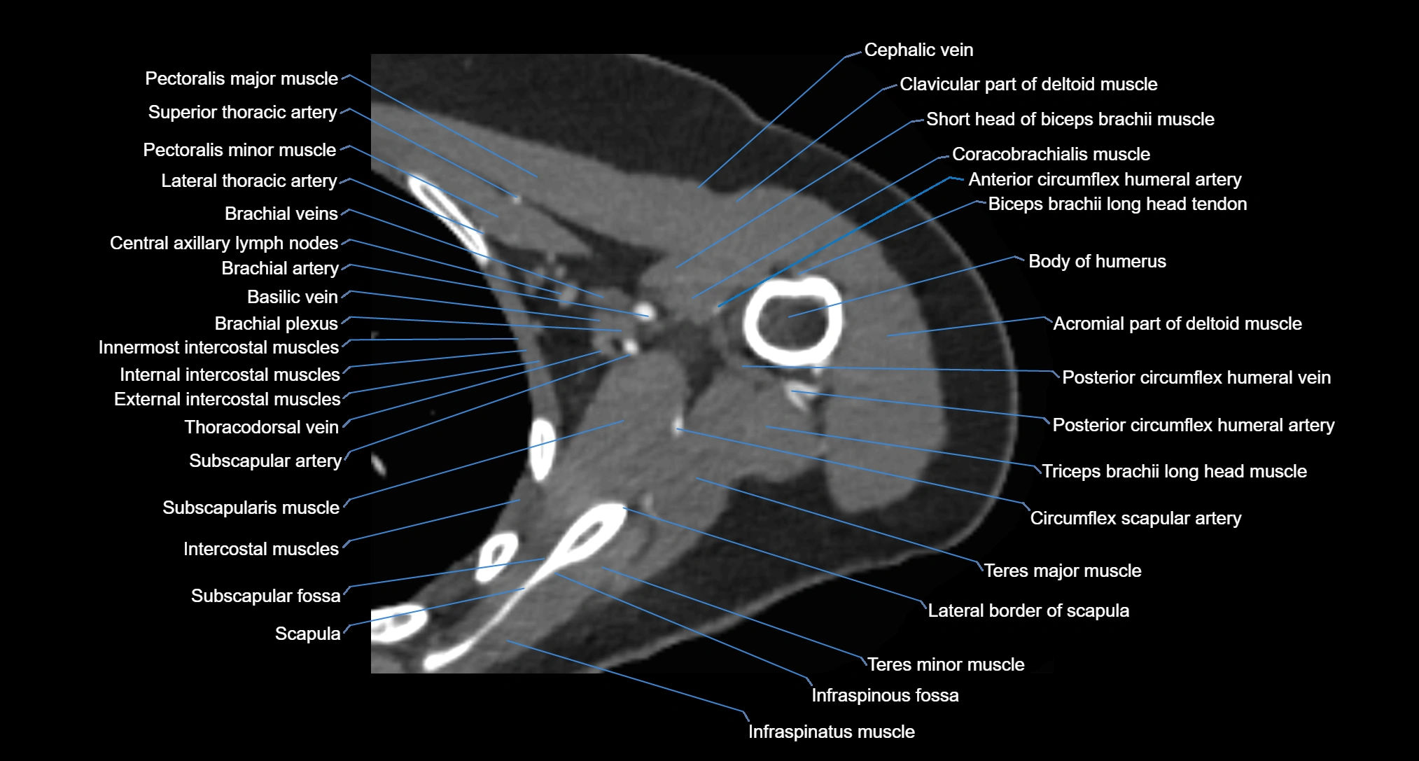 CT Shoulder axial cross sectional anatomy labelled radiology image -00049.webp
